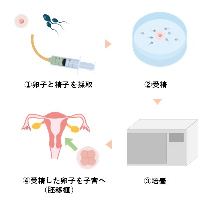 体外受精の方法